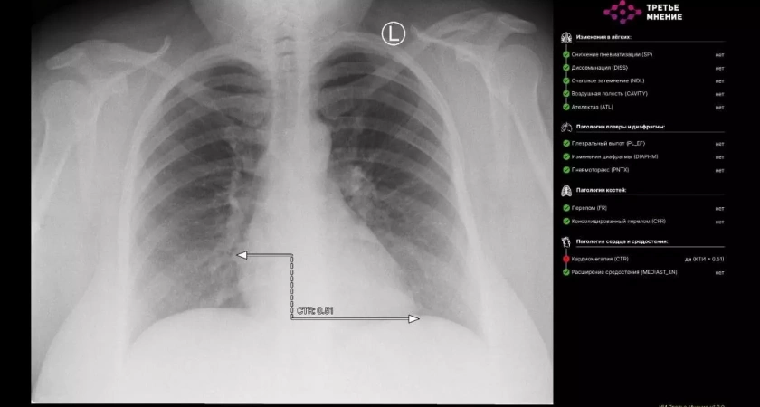 В Башкирии впервые применили искусственный интеллект для расшифровки рентгеновских снимков