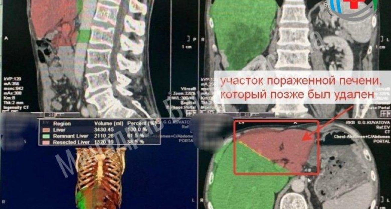 Врачи спасли пациента с опухолью печени 11 см, «вырастив» новый орган по методике ALPPS