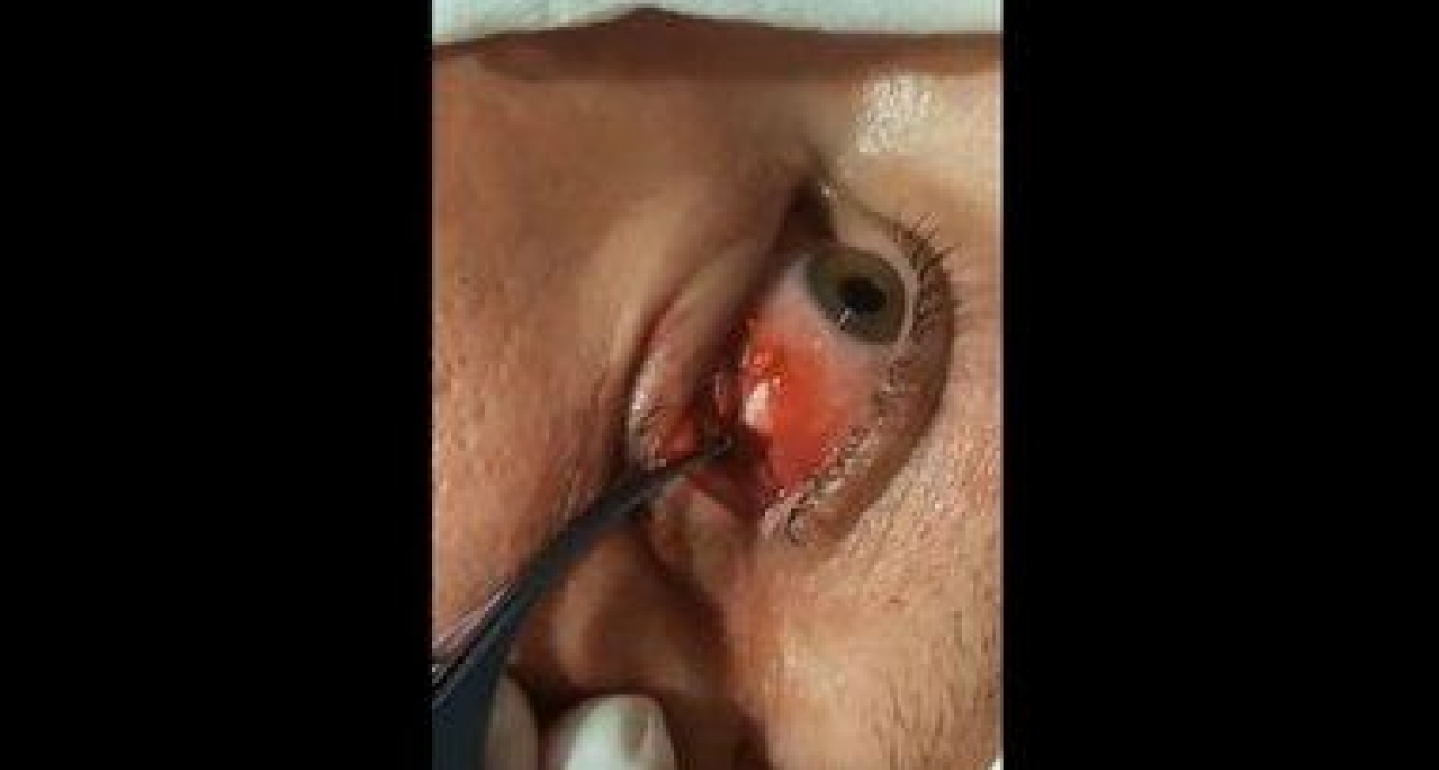 Удар кувалдой выстрелил металлом в глаз: как уфимские хирурги спасли зрение строителю